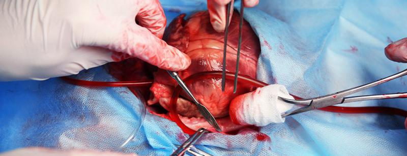 Kalp Damar Tıkanıklığı Ameliyatı