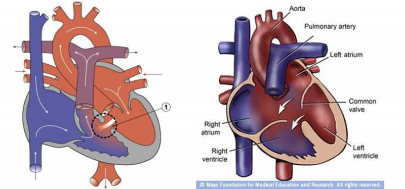 Konjenital Kalp Hastalıkları
