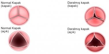 Kalp Kapak Daralmas